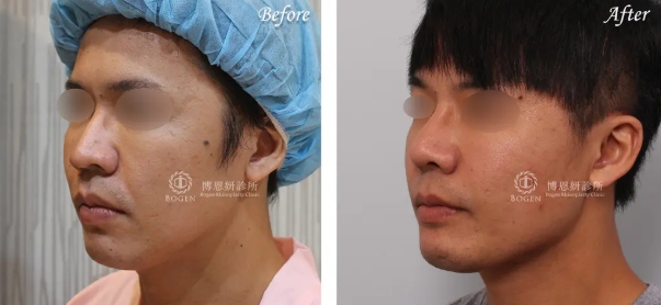 男性隆鼻+下巴手術案例,博恩妍